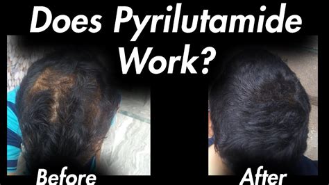 In other news, Kintor pharm is developing a drug called pyrilutamide which is making headway in clinical trials. . Pyrilutamide before and after